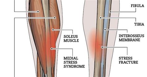 Medial Tibial Stress Syndrome Tibial Stress Injuries Gym Tips