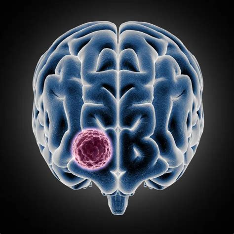 Medulloblastoma A Rare Brain Tumor Credihealth