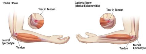 Tennis elbow (lateral epicondylitis), golfer's elbow (medial epicondylitis) lateral and medial epicondylitis are considered to be overload injuries epidemiology1. Tennis Elbow Treatment - High Power Laser Therapy Center
