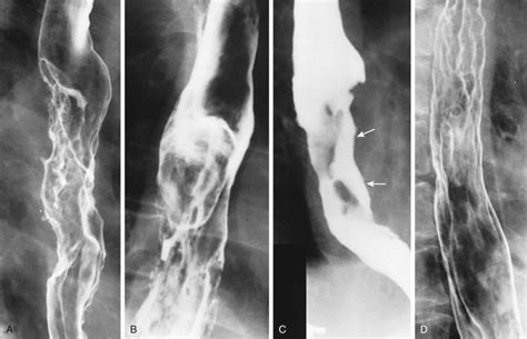 Carcinoma Of The Esophagus Radiology Key