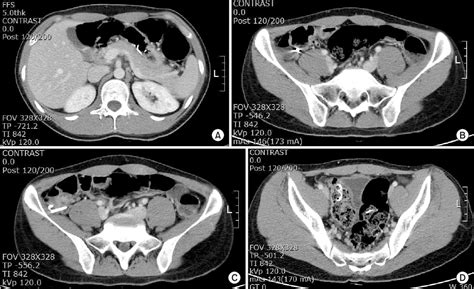 Figure 2 From Acute Appendicitis Caused By Foreign Body Ingestion