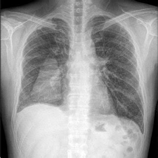 Causes of pleural effusion are generally from another illness like liver disease, congestive heart failure, tuberculosis, infections, blood clots in the lungs, liver failure, and cancer. Chest radiograph showing an absence of lung markings and a pleural line... | Download Scientific ...
