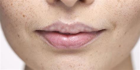 Home Remedies To Get Rid Of White Spots On Lips Home Remedies