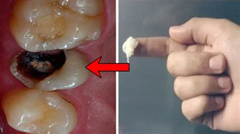 How To Remove Teeth Cavity Fast In 2 Minutes Get Rid Of Teeth Pain