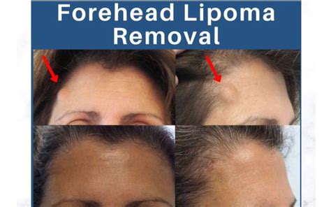 Lump And Bump Removal By Carniol Plastic Surgery In Summit Nj Alignable