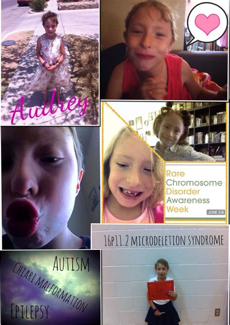 my daughter audrey has 16p11 2 microdeletion syndrome it s rare chromosome disorder awareness