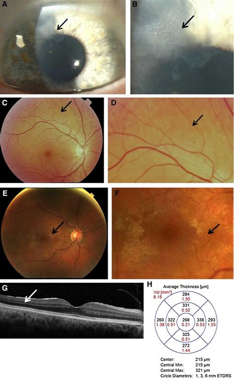 Alport Syndrome Causes Symptoms Diagnosis Prognosis And Treatment