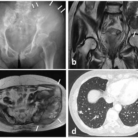Case 4 Sacrum Aneurysmal Bone Cyst A B Plain Radiographs And 3d Ct