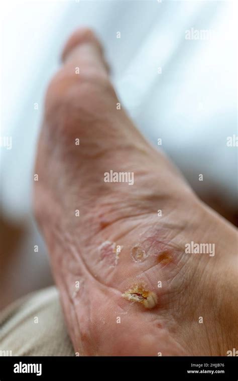 Vesicular Endogenous Eczema Hi Res Stock Photography And Images Alamy