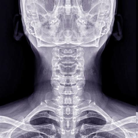 X Ray C Spine Or X Ray Image Of Cervical Spine Ap View For Diagnostic