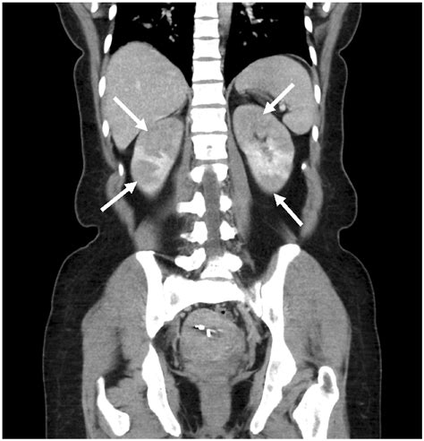 Ct Scan Of Bilateral Renal Infarctions Ct Scan Of Abdomen And Pelvis