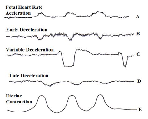 Figure Fetal Heart Rate Changes Contributed By Jennifer Choe Ma