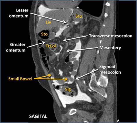 Figure 12 From Peritoneal Cavity Anatomy In Ct Peritoneography A