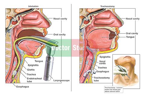 Classic Intubation And Tracheostomy Procedures Doctor Stock