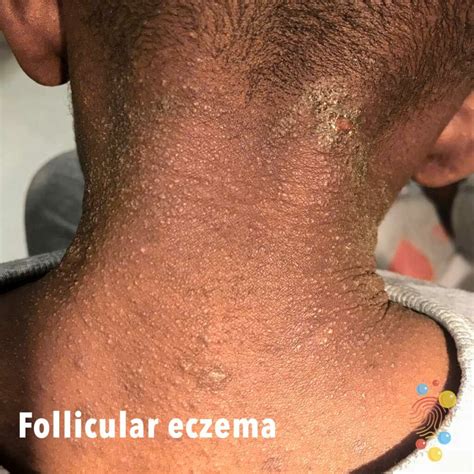 Eczema On Neck