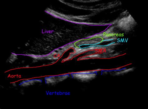 Abdominal Aorta Normal Ultrasoundpaedia