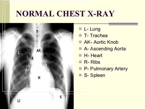 Chest X Ray Pathology