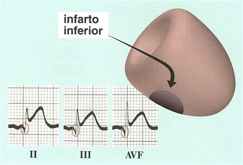 Electrocardiograma Y Medicina General Infarto Agudo De Miocardio De Cara Inferior