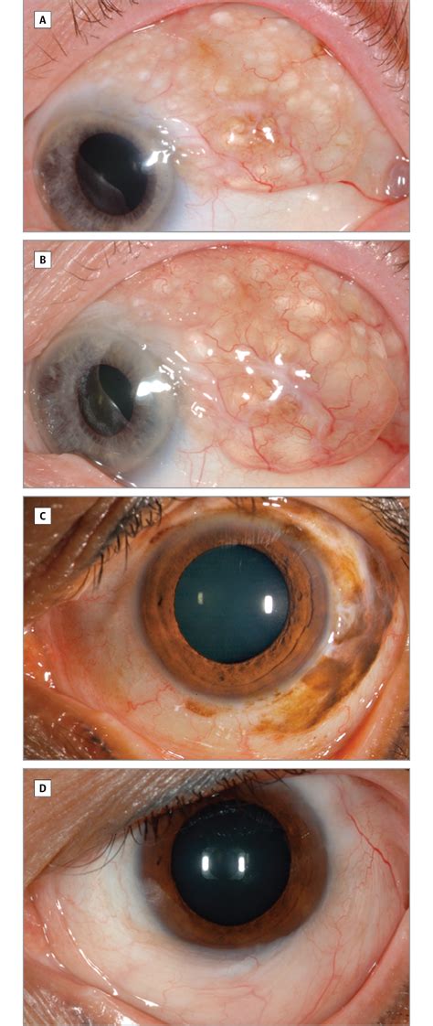 Giant Conjunctival Nevus Clinical Features And Natural Course In 32