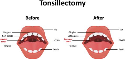 Tonsil Stones Ent Doctor Shares 4 Ways To Get Rid Of These Stinky Masses