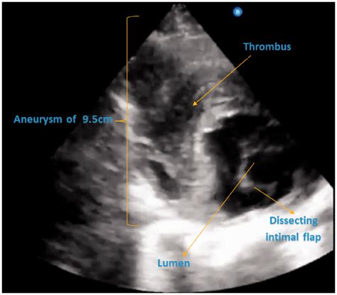 Ultrasound Diagnosis Of Dissecting Thoracic Aortic Aneurysms Procedure
