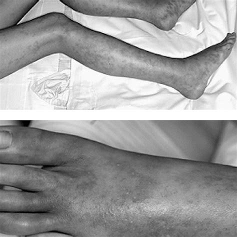 Nodular Erythematous Rash And Swelling On The Lower Extremities And