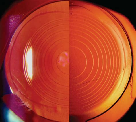 Panoptix Trifocal Lens Uses Of Panoptix Trifocal Lens