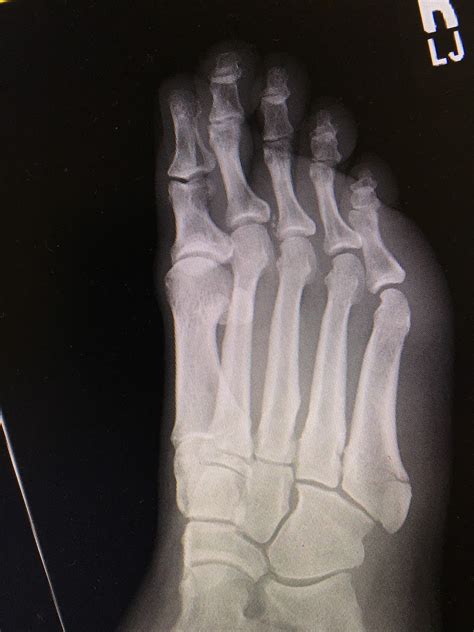 Dr Drew Chapman Foot And Ankle Facts Jones Fractures