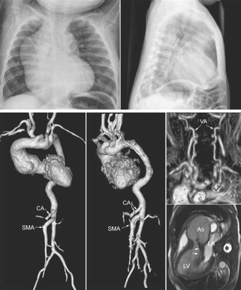 Rheumatic Fever And Acquired Valvular Heart Diseases Radiology Key