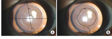 Figure From Rotational Stability Of AcrySof Toric Intraocular Lens Over Time Influence Of