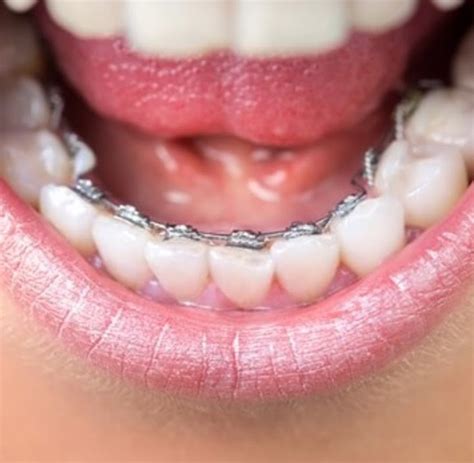 Lingual Braces Hidden Braces Narellan Harris Orthodontics
