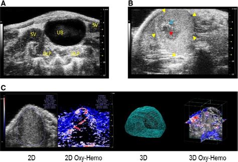 Representative 2d Ultrasound Images Of Prostate And Prostate Tumor