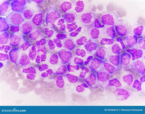 Blast Cells In Leukemia Stock Photo Image Of Medical 92345614