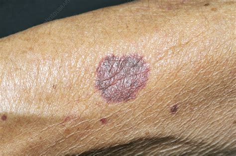 Bruised Arm Stock Image C0016707 Science Photo Library