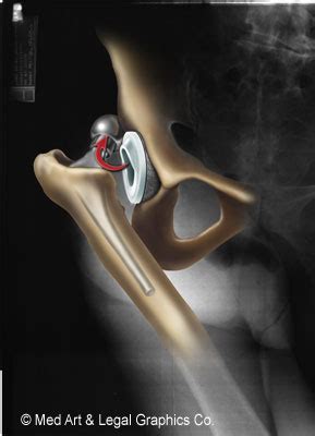 artificial hip dislocation