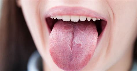 Why Is Your Tongue White Doctors Talk About The Causes With Images
