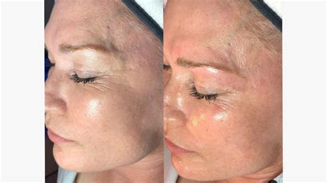 Hydrafacial Skin Treatment Bradford Myskyn