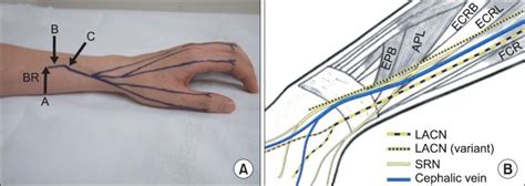 Distribution Of Superficial Radial Nerve A And Cephalic Vein B In