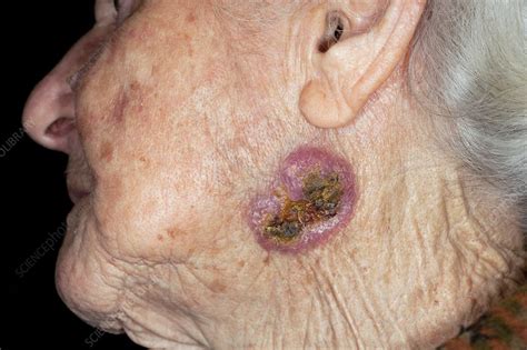 Basal Cell Skin Cancer On The Face Stock Image C0110344 Science Photo Library