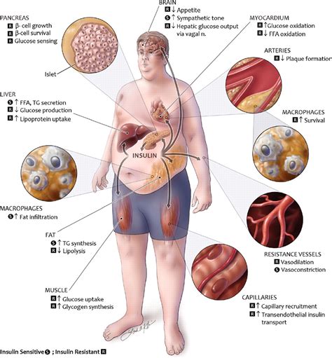 Sindromul Metabolic Cauze Si Tratament