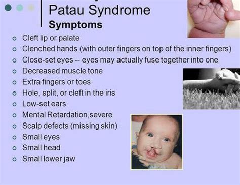 These Are The Symptoms Of Patau Syndrome Medizzy