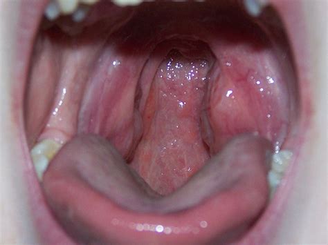 White Spot On Tonsil 7 Causes And How To Treat It