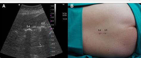 Figure From Ultrasound Assisted Localization For Lumbar Puncture In