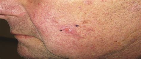 Squamoid Eccrine Ductal Carcinoma A Case Report And Review The