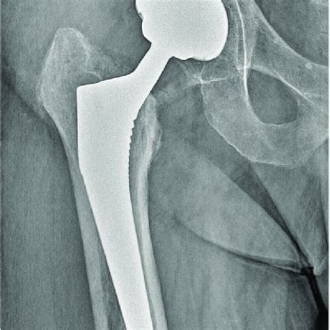 Johansson Classification Of Periprosthetic Fractures Of The Femur