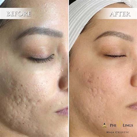 Microneedling Effects Risks Cost Pain Recovery Before And After