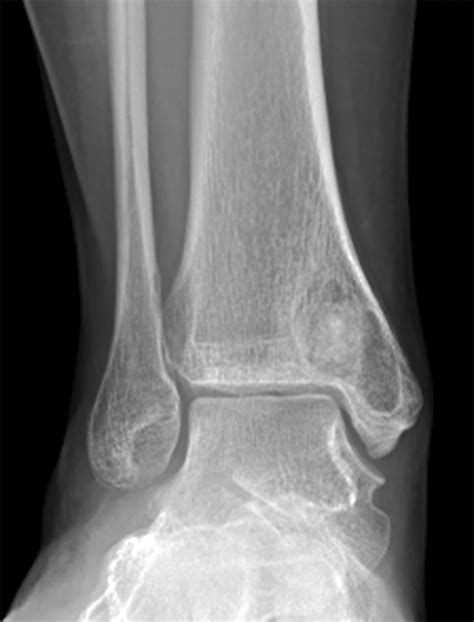 Failure Of Consolidation Of A Peri Articular Distal Tibial Bone Cyst