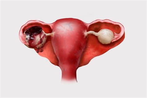 Endometrioid Ovarian Cyst Symptoms And Treatment