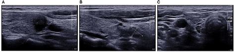 Frontiers An Ultrasound Radiomics Nomogram For Preoperative
