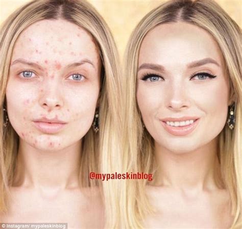 Acne Blogger Slams Questions About Her Skin Daily Mail Online